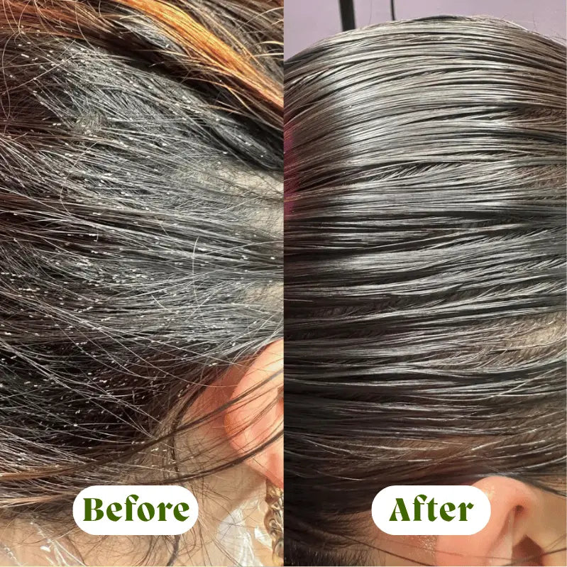 GlideAway™ - 2 Step Clinical Lice & Nits Elimination System